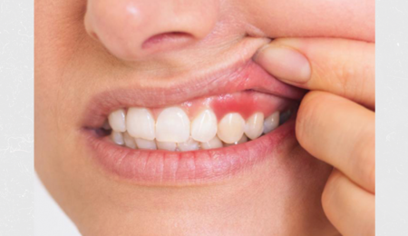 Periodontia: O Pilar da Saúde do Seu Sorriso